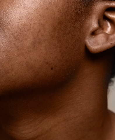 Hyperpigmentation logo